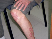 ПСОРИАЗИС - помощ от природата ПСОРИАЗИС - помощ от природата